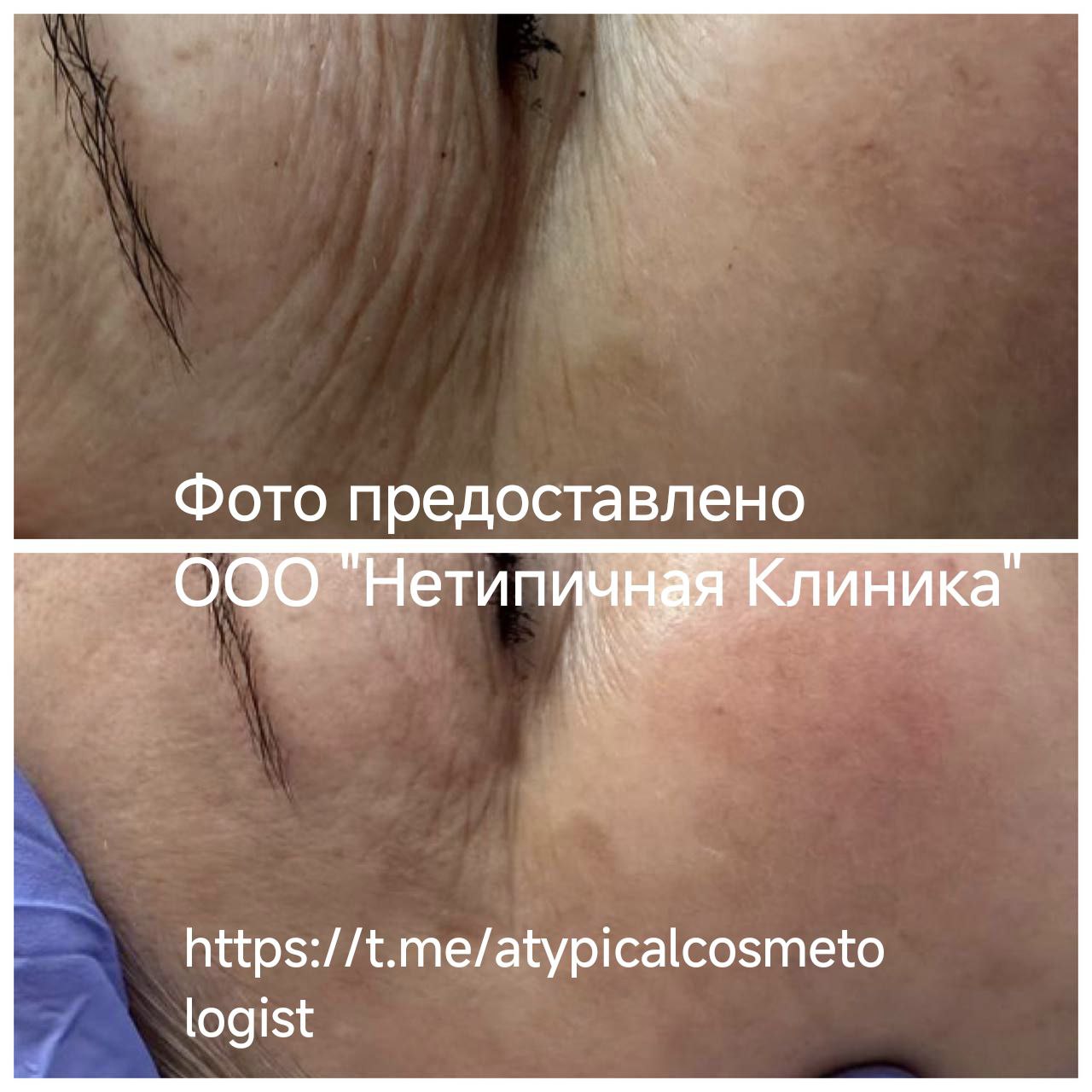 Аппарат для низкоинтенсивной лазерной терапии "SOFTRAY&reg;"