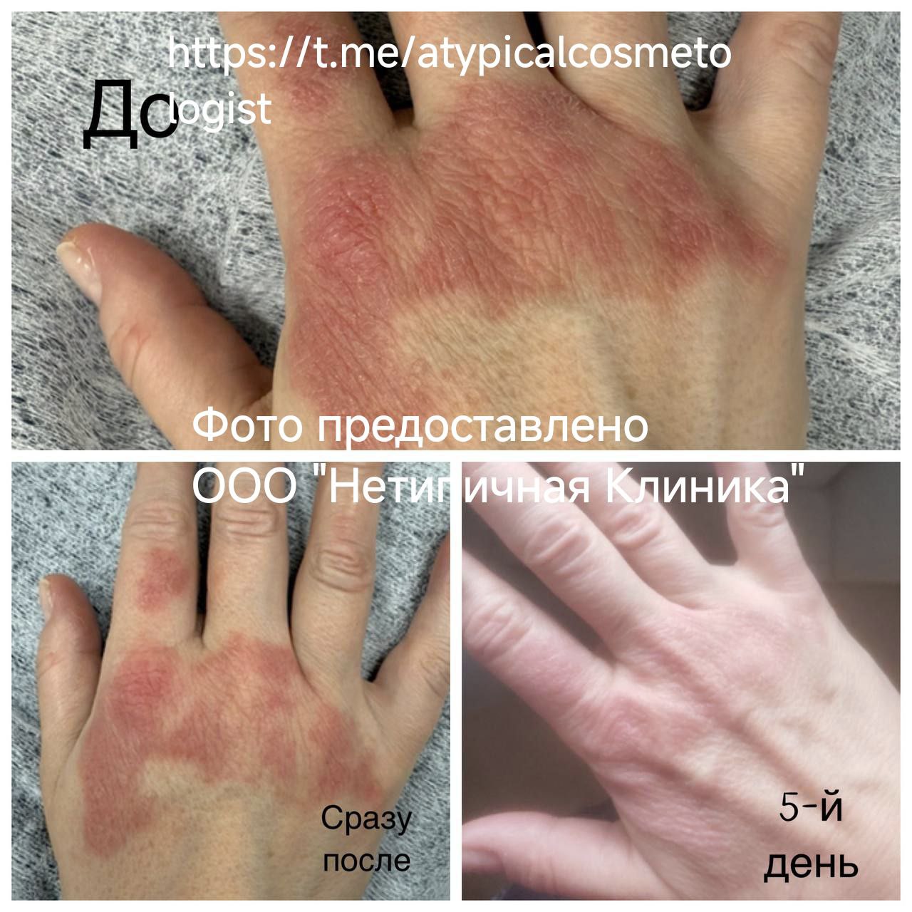 Аппарат для низкоинтенсивной лазерной терапии "SOFTRAY&reg;"